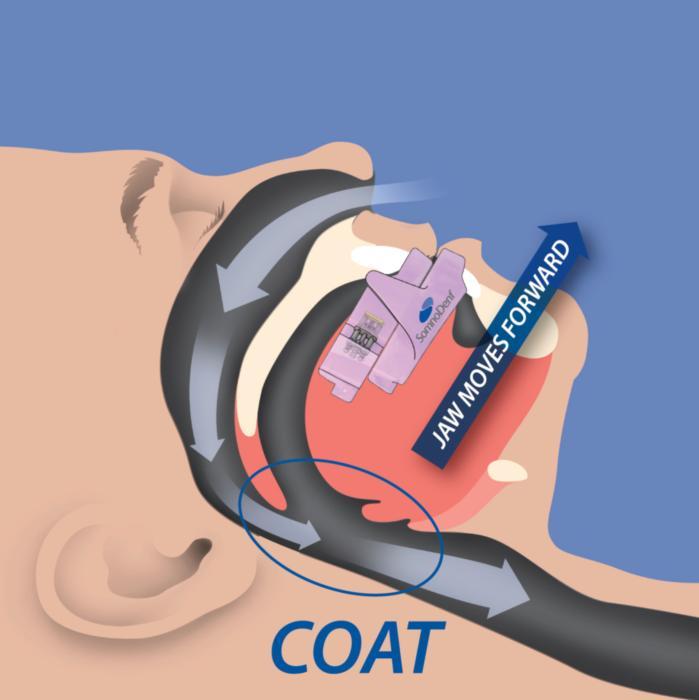 Illustration of sleep apnoea appliance