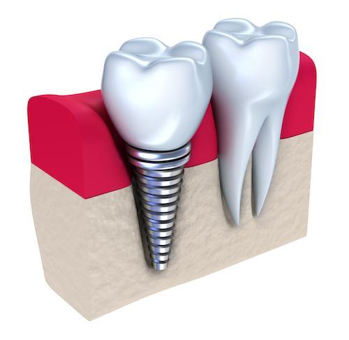 close up of dental implant | dental implants clifton hill vic