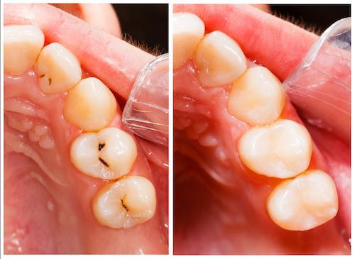before and after teeth with clear dental fillings
