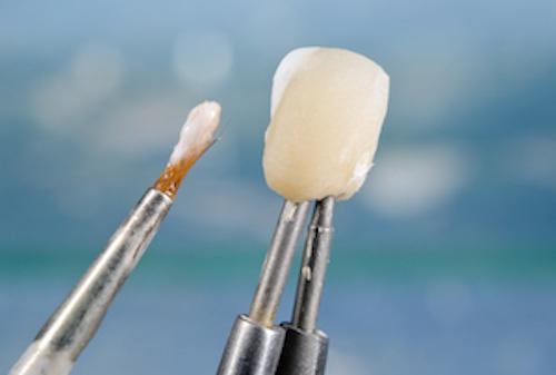 dental veneer | cosmetic dentist clifton hill