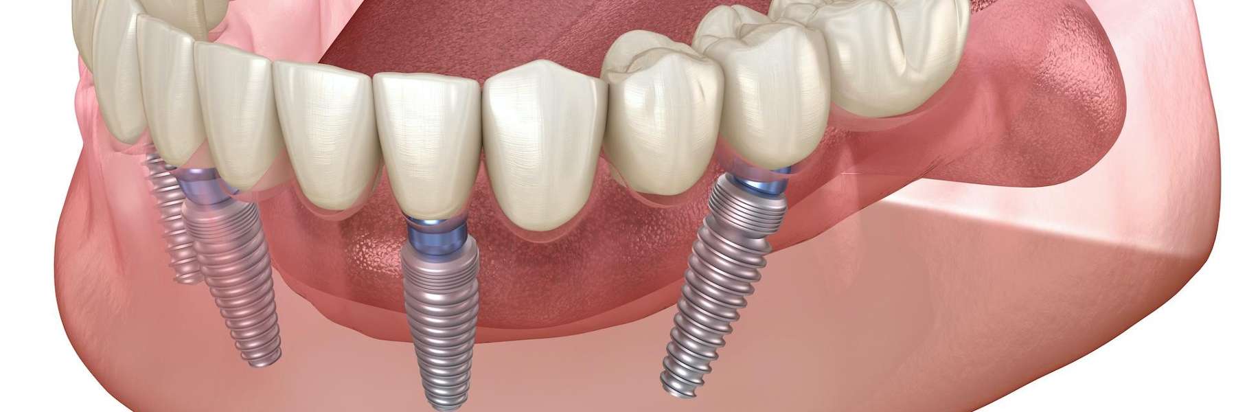 close up of denture in mouth | all on 4 clifton hill