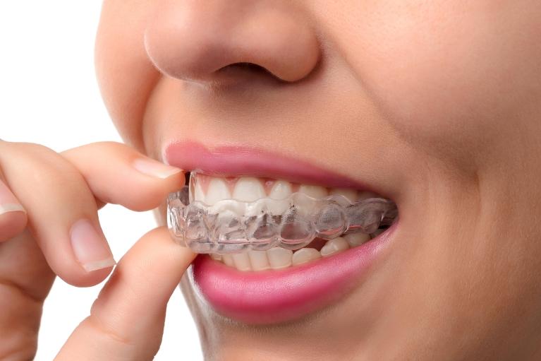 woman putting in clear aligner l orthodontics clifton hill vic