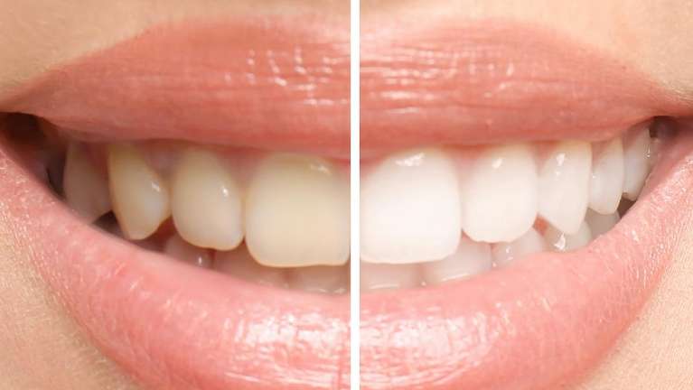 A before and after of professional teeth whitening | dentist Clifton Hill