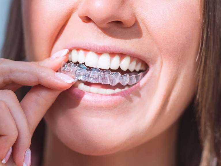 A woman putting in her Invisalign tray | Invisalign Clifton Hill Vic