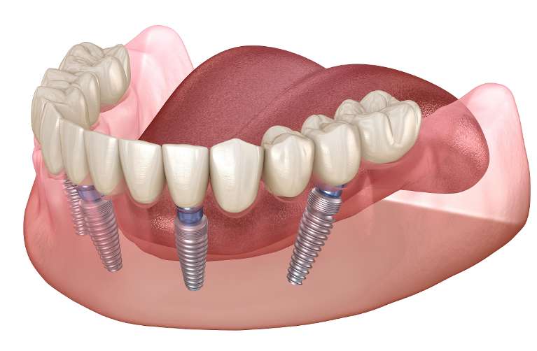 close up of dental implants in jaw | clifton hill dental implants