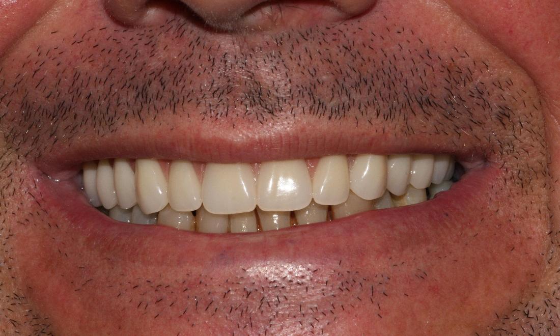 After Image of All-on-4 | dentist clifton hill