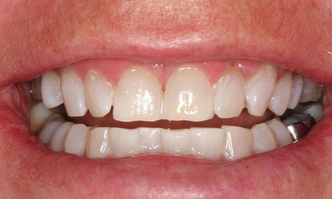 Image of patient after zoom whitening