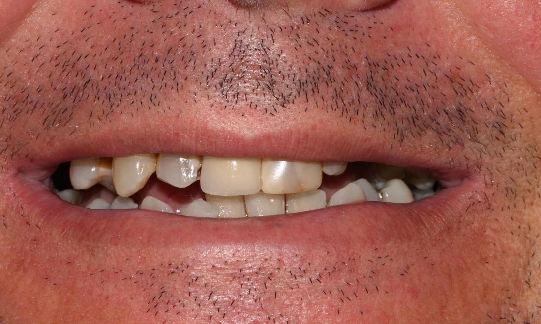 Before Image of All-on-4 | all-on-4 clifton hill vic