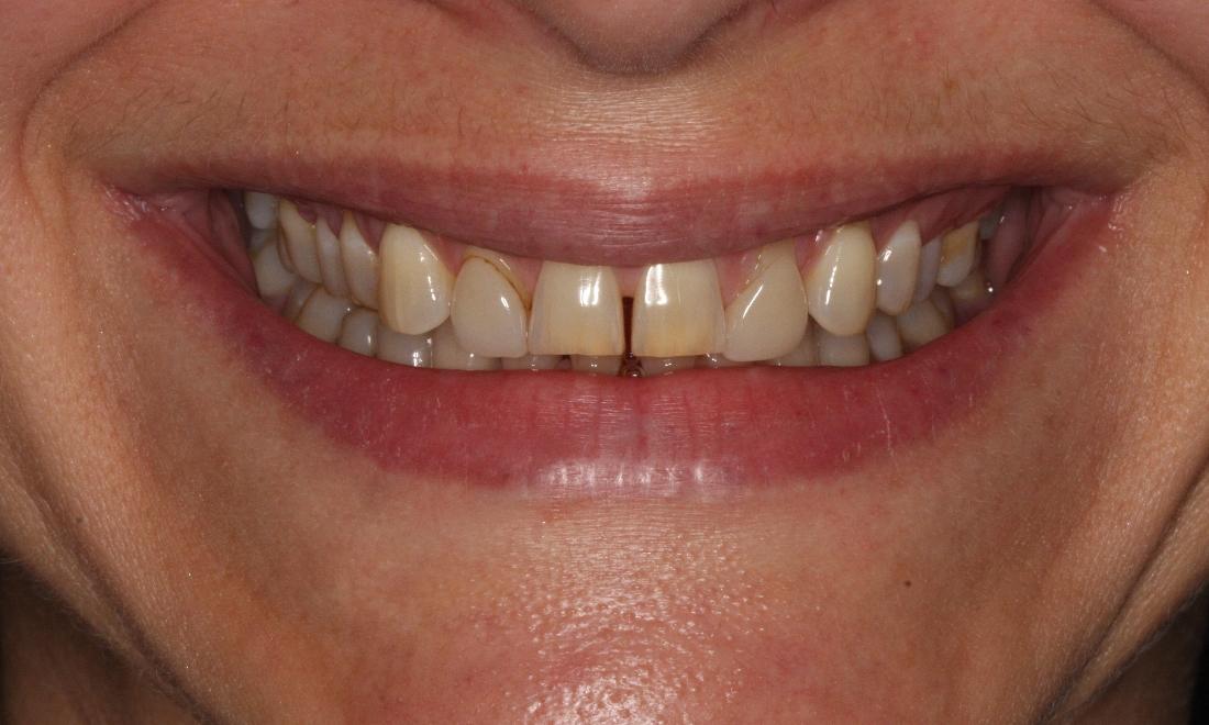 Image of smile before porcelain veneers