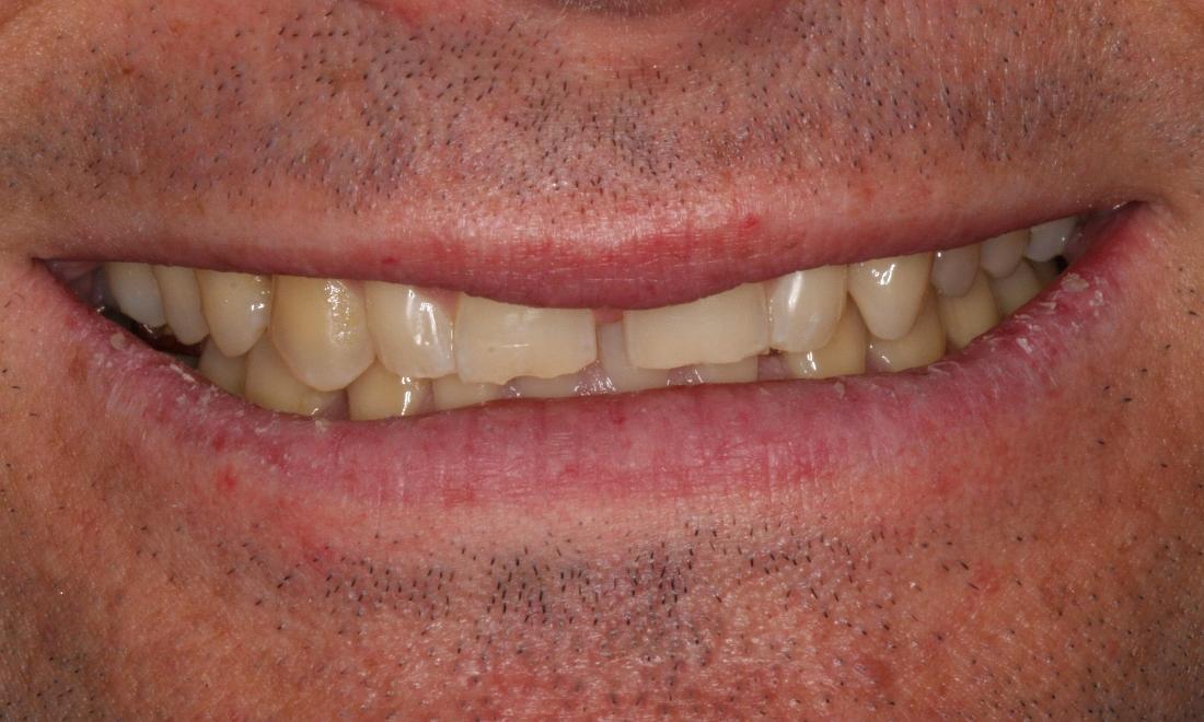 man with yellowed teeth and a gap in front teeth