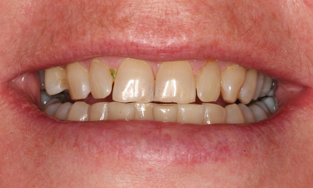 Image of patient before zoom whitening | cosmetic dentist clifton hill
