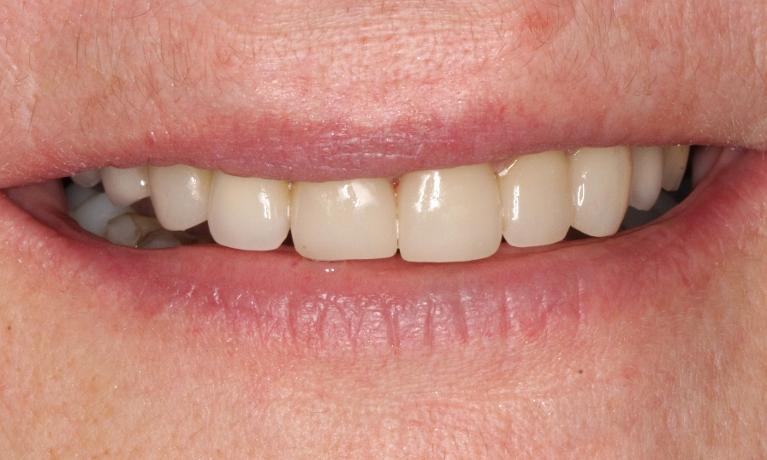 Image after dental treatment of the patient | dentist clifton hill