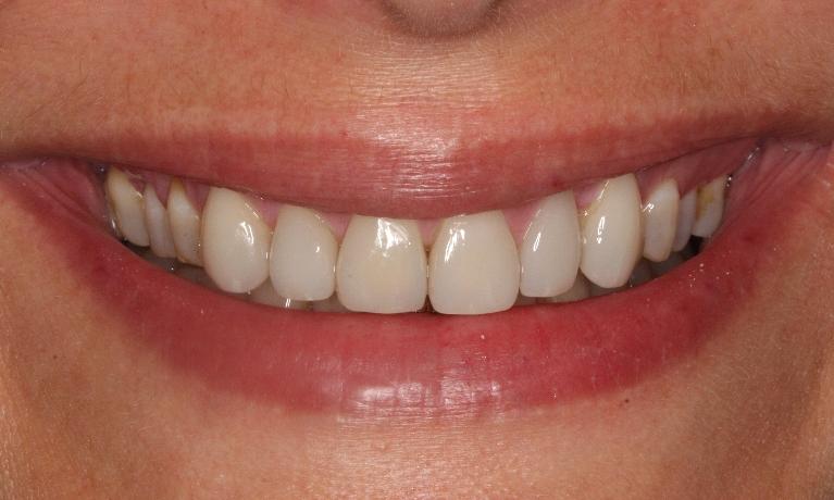 Porcelain-Veneers-After-Image
