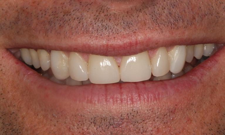 Porcelain-and-Composite-Veneers-with-Whitening-After-Image