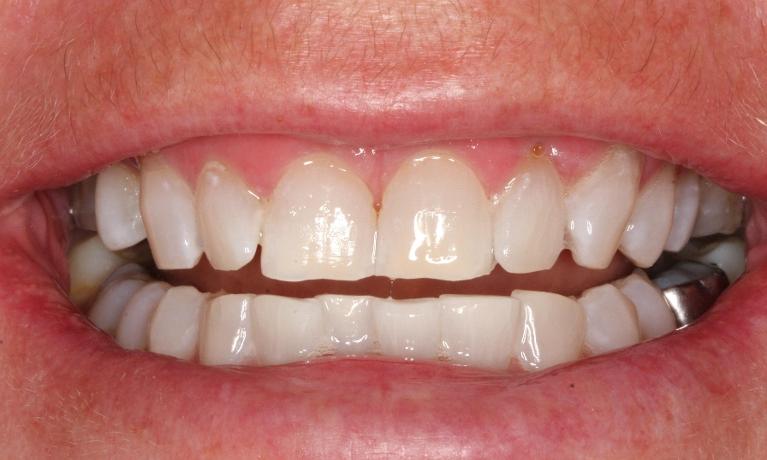Zoom-Teeth-Whitening-After-Image