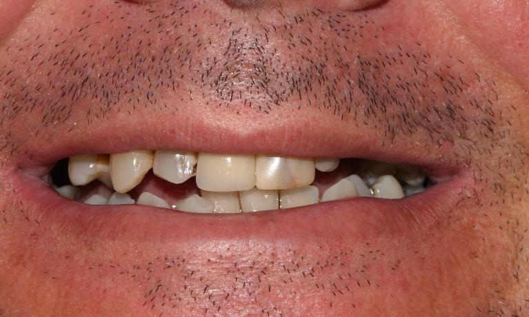 Discover-All-on-4-Before-Image