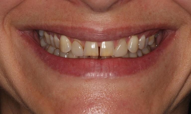 Porcelain-Veneers-Before-Image