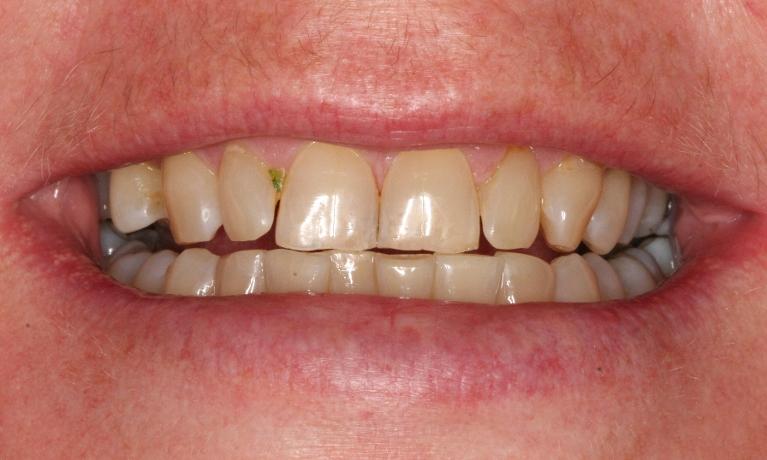 Zoom-Teeth-Whitening-Before-Image